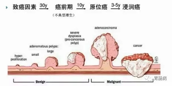 體檢查出腸息肉一定要切除！ 95%腸癌由它演變而來(lái)
