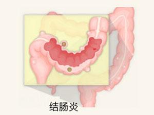 南寧治療結腸炎要花多少錢