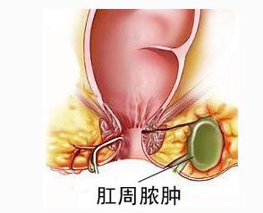 南寧肛周膿腫必須手術嗎