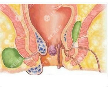 南寧哪個(gè)醫(yī)院可以做肛周膿腫？