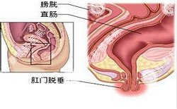 南寧治療脫肛哪家醫(yī)院好？南寧脫肛治療多少錢？